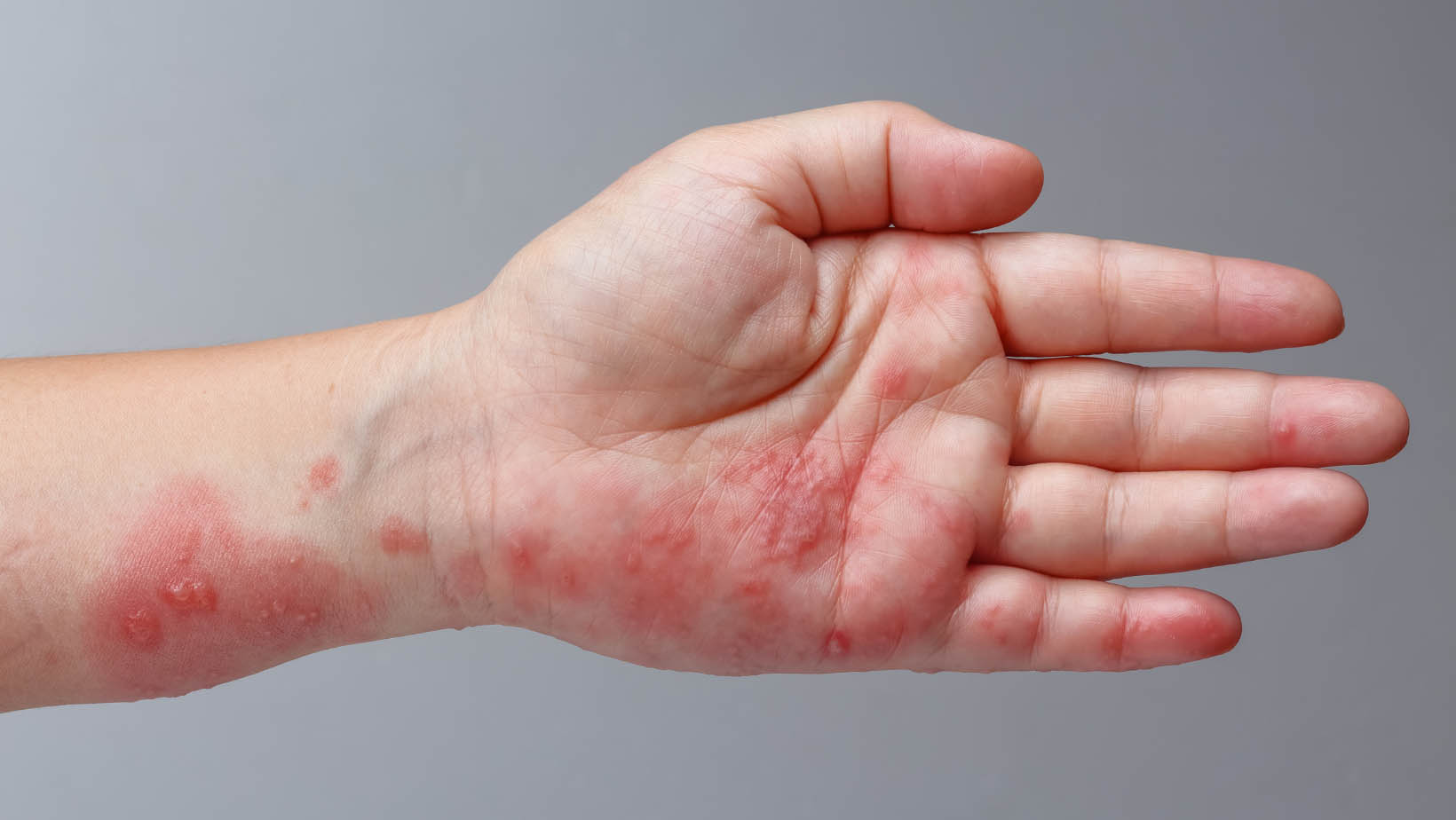 photo of hand with rashes