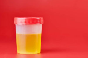 Urinalysis for urolithiasis in container. Urine samples for analysis in laboratory.