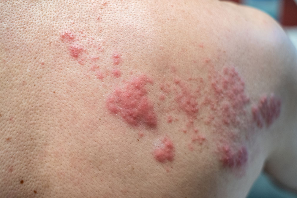 image of skin rash and blisters
