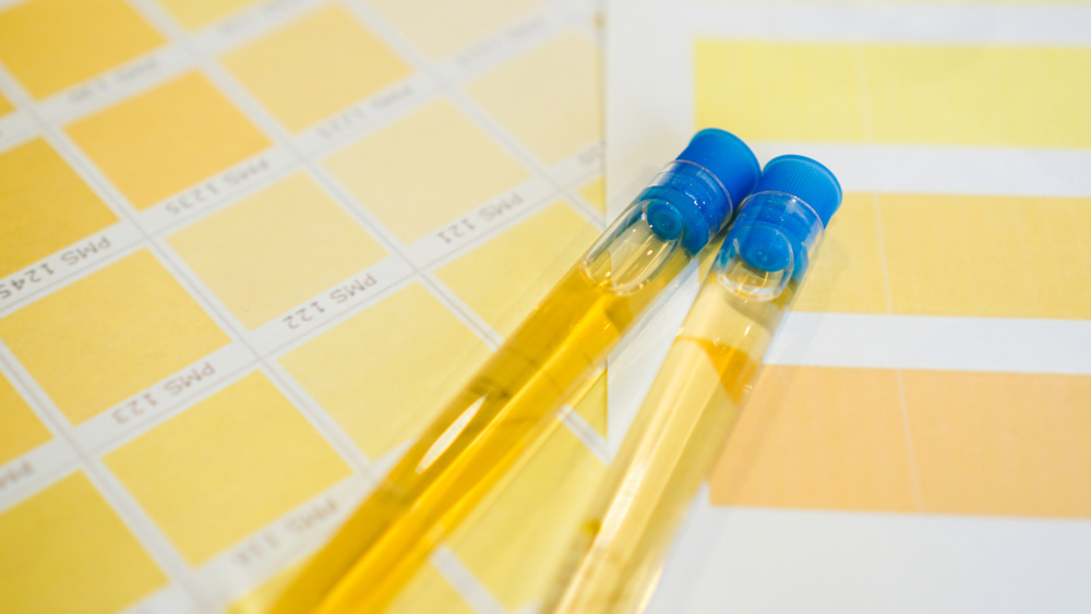Urine tubes are placed on color charts.