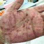 What Does a Syphilis Rash Look Like - RTTC