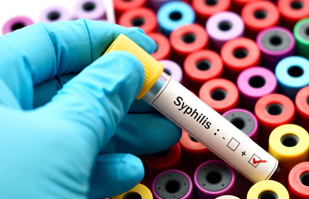 Syphilis Diagnosis